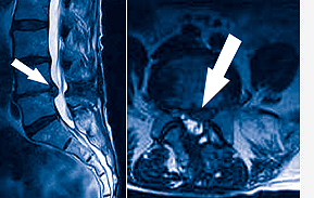 Die Abb. 04 zeigt die MRT-Bilder vor der Behandlung mit Discogel.