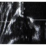 Abb. 1: Sonographie einer normalen Hüfte 1=Pfannenboden 2=Beckenknochen 3=Pfannendach