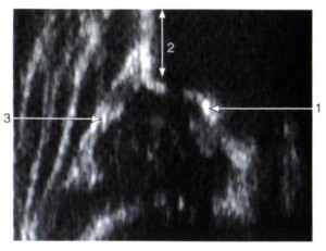 Abb. 1: Sonographie einer normalen Hüfte 1=Pfannenboden 2=Beckenknochen 3=Pfannendach