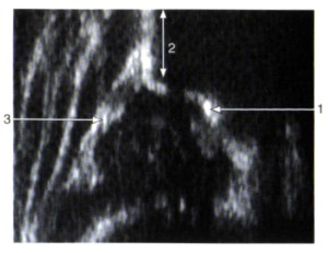 Abb. 1: Sonographie einer normalen Hüfte 1=Pfannenboden 2=Beckenknochen 3=Pfannendach