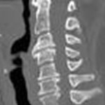 Osteochondrose